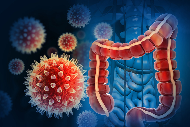 A visual description of colon cancer