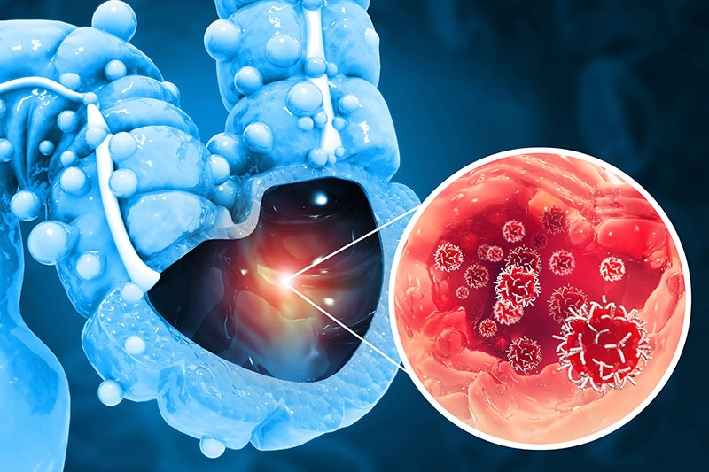 A patient preparing for his colorectal surgery